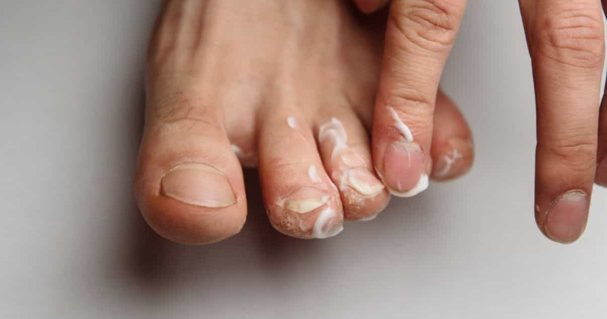 silka cream is a great athletes foot treatment 